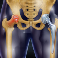  Hip Replacement 